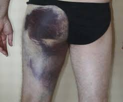 Most hamstring injuries are caused when the muscles are overloaded. Proximal Hamstring Injury Robert Howells