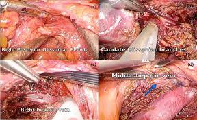 We did not find results for: Laparoscopic Isolated Caudate Lobe Resection Scientific Reports