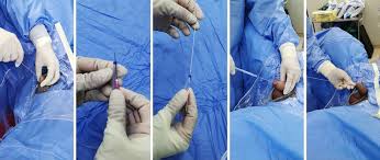 Image result for Urethral Catheterization