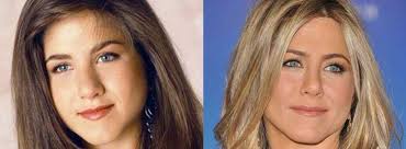 Você pode conferir esses e outros casos de rinoplastia em famosos aqui! Meus Lindos E Pagos Arquivos Rinoplastia De Famosas