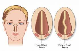 Maybe you would like to learn more about one of these? Septoplasty Gold Coast Brisbane Dr Mark Doyle Plastic Surgeon