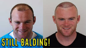 Welcome to the official website of wayne rooney, where you can learn more about wayne, the wayne rooney foundation and keep up to date with his latest news. Wayne Rooney Had 2 Hair Transplants And Is Still Losing Hair Youtube