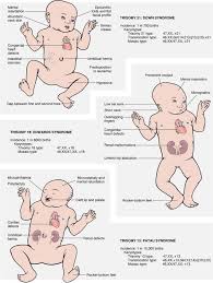 Edwards' syndrome definition edwards' syndrome is caused by an extra (third) copy of chromosome 18. Trisomies 13 Patau Syndrome 18 Edwards Syndrome 21 Down Syndrome Neonatal Nurse Pediatric Nursing Newborn Nursing