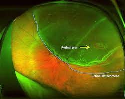 It's often accompanied by the sudden onset of symptoms such as floaters and flashing lights. Floaters Retinal Tears And Retinal Detachments Visionaware
