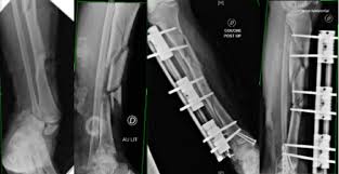 Votre mission consisitera en l'accueil et au conseil des clients, l'encaissement des achats, la mise en rayon des produits et la gestion des stocks. Multidisciplinary Management Of The Bone And Joint Infection Complicating Treatment Of An Open Fracture Of The Lower Limb Sciencedirect