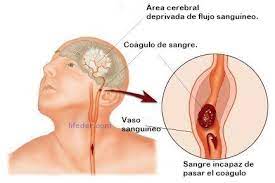 We did not find results for: Ictus Diferencias Entre Trombo Y Derrame Tratamientoictus Com