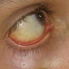 Leicht Gelbliche Augen Gesundheit Medizin Leber