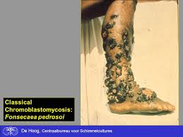 Fonsecaea pedrosoi is a dematiaceous fungus and the main causative agent of chromoblastomycosis that is a chronic disease usually affecting the human skin and subcutaneous tissues. Fungal Infections Pathogenesis And Treatment Ppt Video Online Download