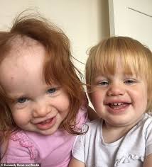 So for this post, we are going to cover the hair removal treatments available for kids/tweens/teens as well as the pros and cons for each to help you and your teen make an informed decision. Toddler Ends Up Looking Like Pennywise From It After Putting Hair Removal Cream On Her Locks Daily Mail Online