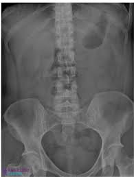 Image result for Abdominal XRay