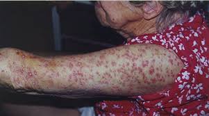 Image result for Fire Ant Sting