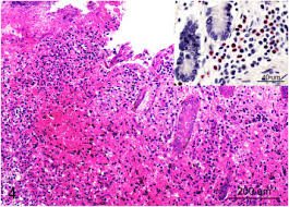 Image result for Balantoides Coli