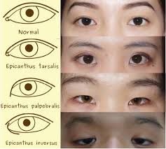 Epicanthic folds is a skin fold on the upper eyelid which covers the inner angle of the eye, which makes them appear smaller and more slanted, even if the eye itself is no different from an eye with no epicanthic fold. Update On Asian Eyelid Anatomy And Periocular Aging Change Springerlink