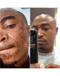 My friend's was diagnosed of the disease last year and . Dr Sandi Medical Aesthetics Dr Sandi Medical Aesthetics