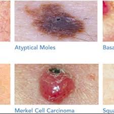 How can i tell if the new moles developing on my skin are cancerous? Different Kinds Of Skin Cancer Classified By The Skin Cancer Foundation Download Scientific Diagram