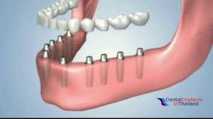 Dentures are definitely better than not having any teeth, but dental implants are the next step up. Innovative Treatment Options In Thailand For Missing Teeth Fixed Bridges Dentures Implants Youtube