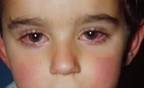Image result for Allergic Conjunctivitis