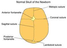 Craniostenosis Facial Bones Pediatric Nursing Sutures