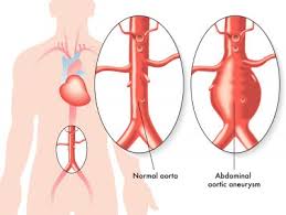 Aneurysma Formen Ursachen Symptome Diagnose Dr Stephans
