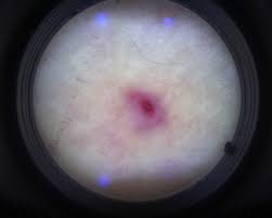 Image result for Pathergy