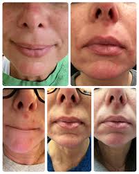 Rowe Casa products heal peri-oral dermatitis