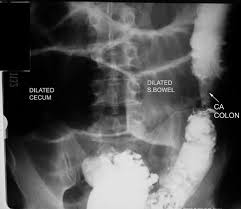 Lower Gi In A Patient With Large Bowel Obstruction Dilated Bowel Loops Proximal To The Obstruction Bowel Obstruction Large Bowel Medical Knowledge
