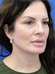 Cases in Facelift Deep Plane