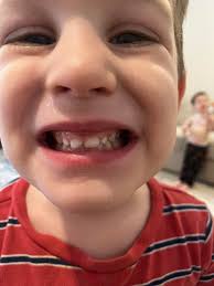 Hi! I have concerns about 2 of my sons. One is 3.5 and the other is 2. The  3.5 year old has a very narrow palette and head in general. I was