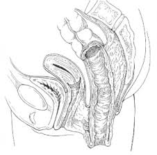 Image result for Rectal prolapse