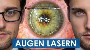 Bis zu welchem alter kann man sich seine augen lasern lassen? Augen Lasern Video Von Der Ganzen Operation Femto Lasik Op Teil 3 Youtube