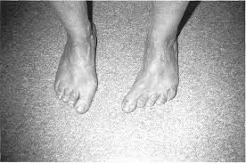 Image result for Hallux Varus