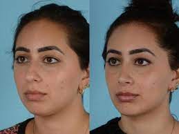 Before & after, followed by 115 people on pinterest. Female Rhinoplasty Before And After Richard Zoumalan