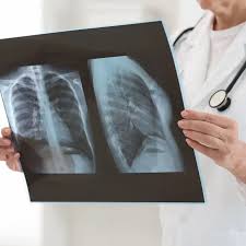 Image result for lung cancer xray