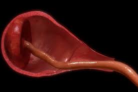 Image result for Retained Placenta