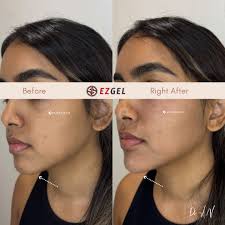 🌟 Dave Ramlal's Morpheus8 Face & Neck Rejuvenation 🌟 For Dave, Morpheus8  has been the go-to solution to target sagging and wrinkles in his face and  neck area. This advanced treatment delivers