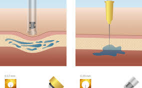 Hyaluron pen sur les lèvres, quelles différences avant après ? Hyaluron Pen Mon Avis Injection Acide Hyaluronique Monan Fr