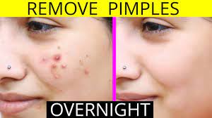 How To Remove Pimples Overnight | Acne Treatment | Anaysa - Youtube
