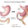 gastric bypass surgery from hospital.uillinois.edu