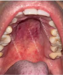 Image result for Physical injury red spots roof of mouth