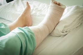 In grade 3 sprains, a ligament has been torn completely. Sleeping Comfortably With Broken Bones Texas Orthopedics