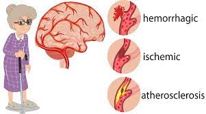 A stroke occurs when blood flow to the brain is interrupted. Stroke Information Resource Guide