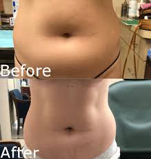 How long do laser lipo results last? Smartlipo Laser Liposuction Treatment Hartford Ct