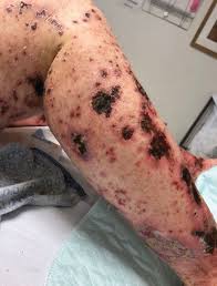 Image result for Vasculitis