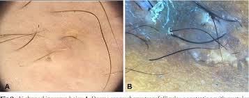 For a few months i've noticed a pimple looking thing on my labia majora (outside of vagina) i do shave the area so i figured it was probably just an ingrown hair. Figure 9 From Clinical Dermoscopic And Histopathologic Features Of Body Hair Disorders Semantic Scholar