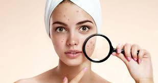 Sivilceye Ne Iyi Gelir Sivilce Izleri Nasil Gecer Iste Sivilce Izlerini Kurutan Maske Tarifleri Saglik Haberleri