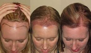 زراعة الشعر للنساء في تركيا