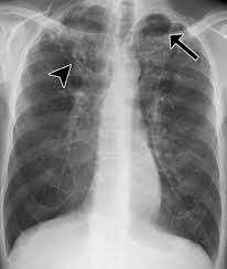 Check spelling or type a new query. Pulmonary Tuberculosis Role Of Radiology In Diagnosis And Management Radiographics