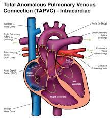 Total Anomalous Pulmonary Venous Return Tapvr Correction Atrial Septal Defect Pulmonary Best Hospitals