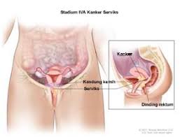 Sakit tulang kemaluan ketika hamilini memang biasa dialami ibu mengandung saat menginjak trimester ketiga kehamilan. Gejala Kanker Serviks Penyebab Biaya Berobat Dokter Smarter Health