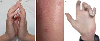 Image result for Systemic Sclerosis